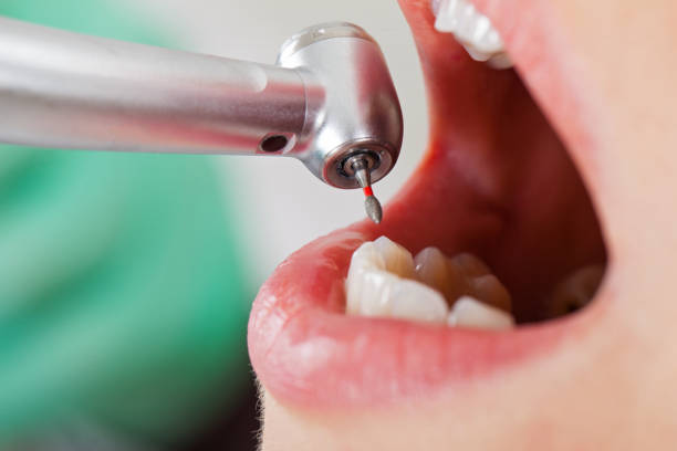 Best Emergency Dentist for Lost Fillings or Crowns in Frederick, OK